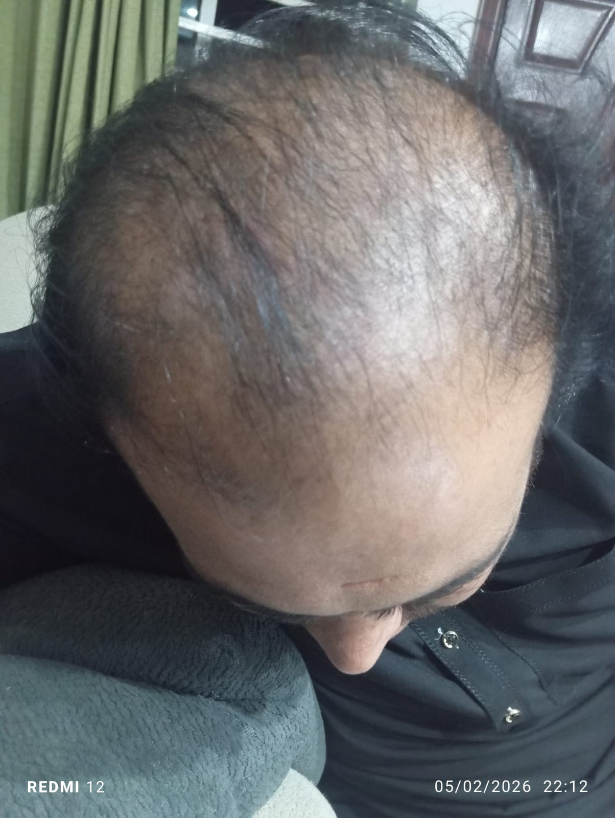 Before hair result